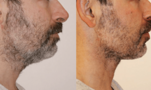 为不被裁员，科技公司男员工扎堆做医美，包括面部拉皮、颈部拉皮、眼睑提升等